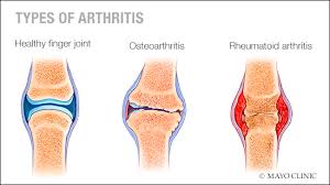 types of arthritis -mayo clinic